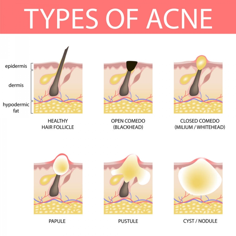 your-guide-to-acne-scar-removal-in-singapore